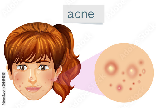 A Young Lady Acne on Face