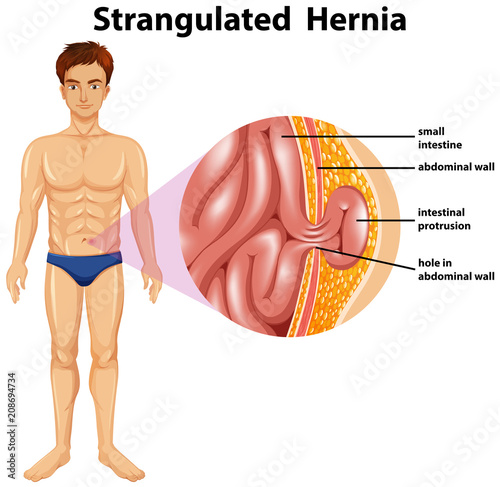 Human Anatomy of Strangulated Hernia