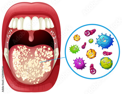A Human Mouth Virus Infection