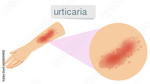 A Human Skin Problem Urticaria