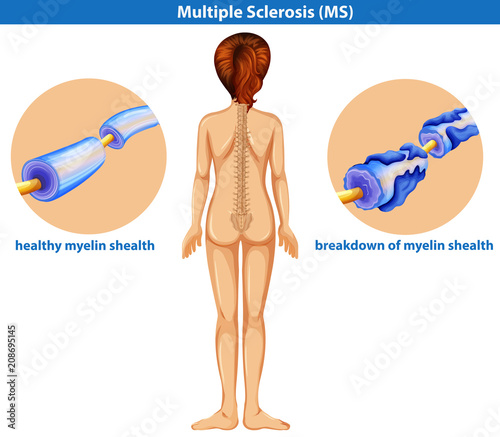 A Medical Vector of Multiple Sclerosis