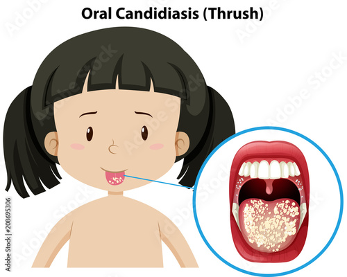 Oral Candidiasis thursh on girl