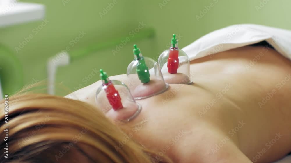 Traditional Chinese Medicine Cupping process. Hijamah Cups on back of ...