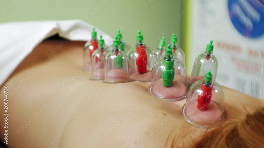 Stockvideon Traditional Chinese Medicine Cupping process. Hijamah Cups ...
