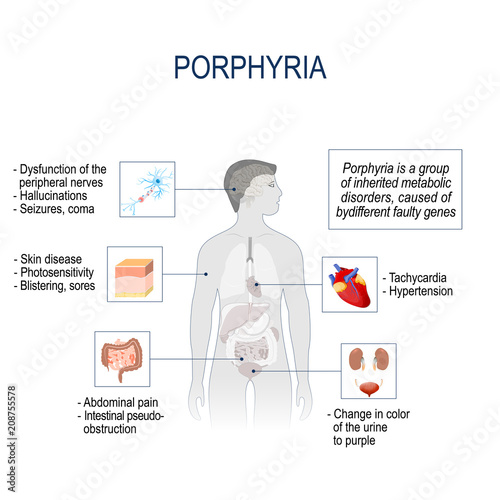 Porphyria. Signs and symptoms. Vector illustration for medical use.