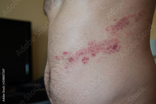 Fotografía close up on herpes zoster on the stomach