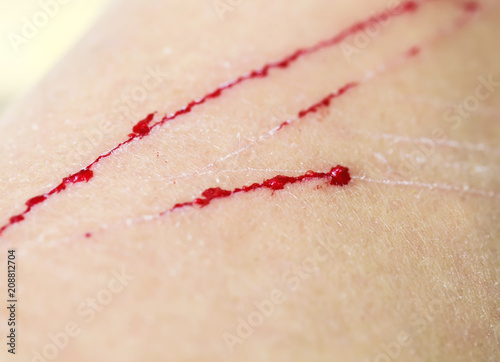 patients with deep wounds and scratches with drops of blood on human skin