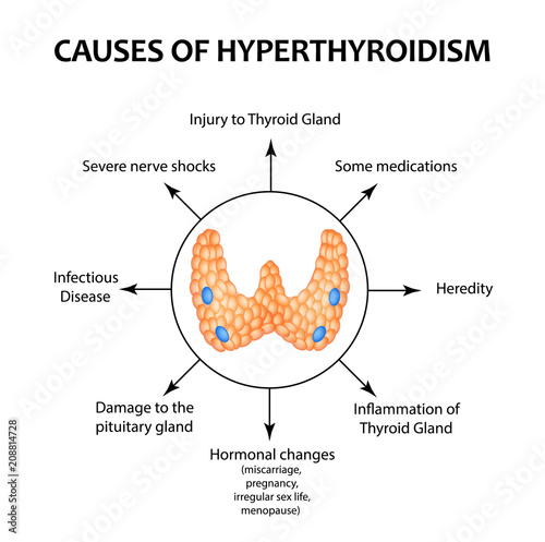 The causes of hyperthyroidism of the thyroid gland. Infographics. Vector illustration on isolated background.