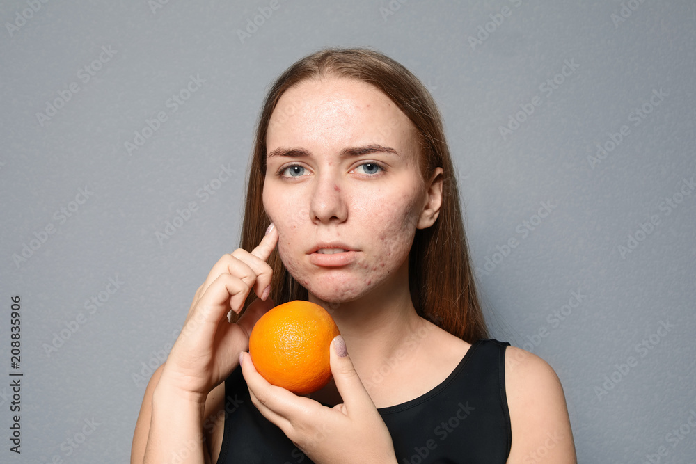 Young woman with acne problem holding orange on color background. Skin allergy Young woman with acne problem holding orange on color background. Skin allergy