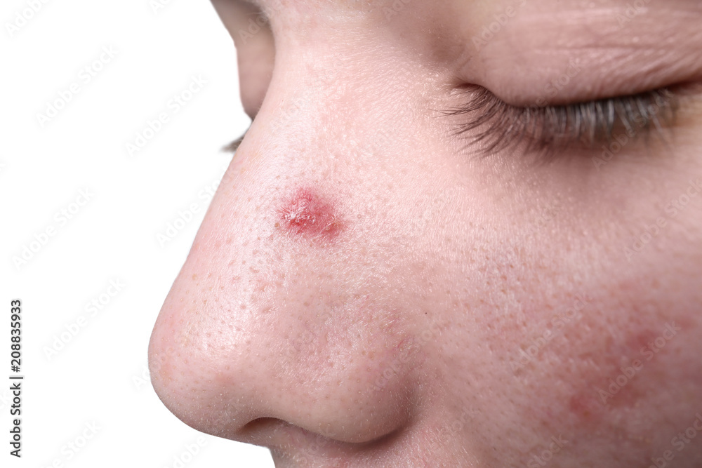 Young woman with acne on her face, closeup Young woman with acne on her face, closeup