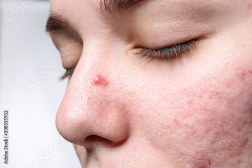 Young woman with acne on her face, closeup