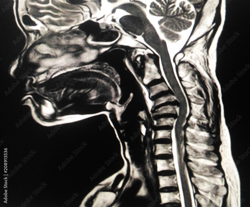 MRI Cspine a female 67 year old.Impression Moderate bening compression