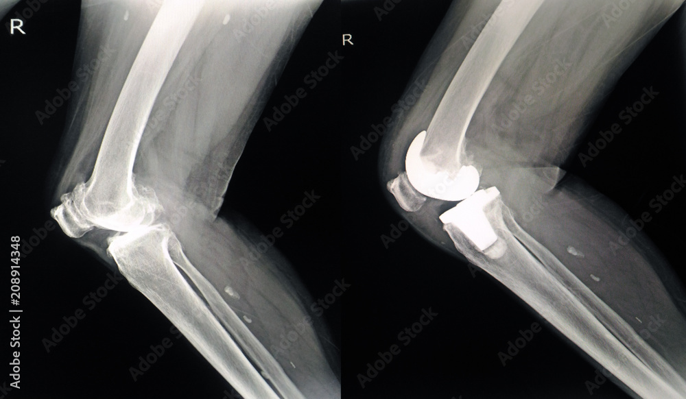 x-ray show knee joint knee Ostoearthritis side view/x-ray show knee ...