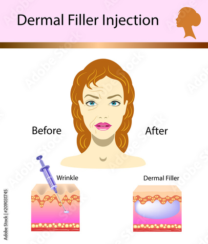 Vector illustration with cosmetic filler or Dermal fillers on white background