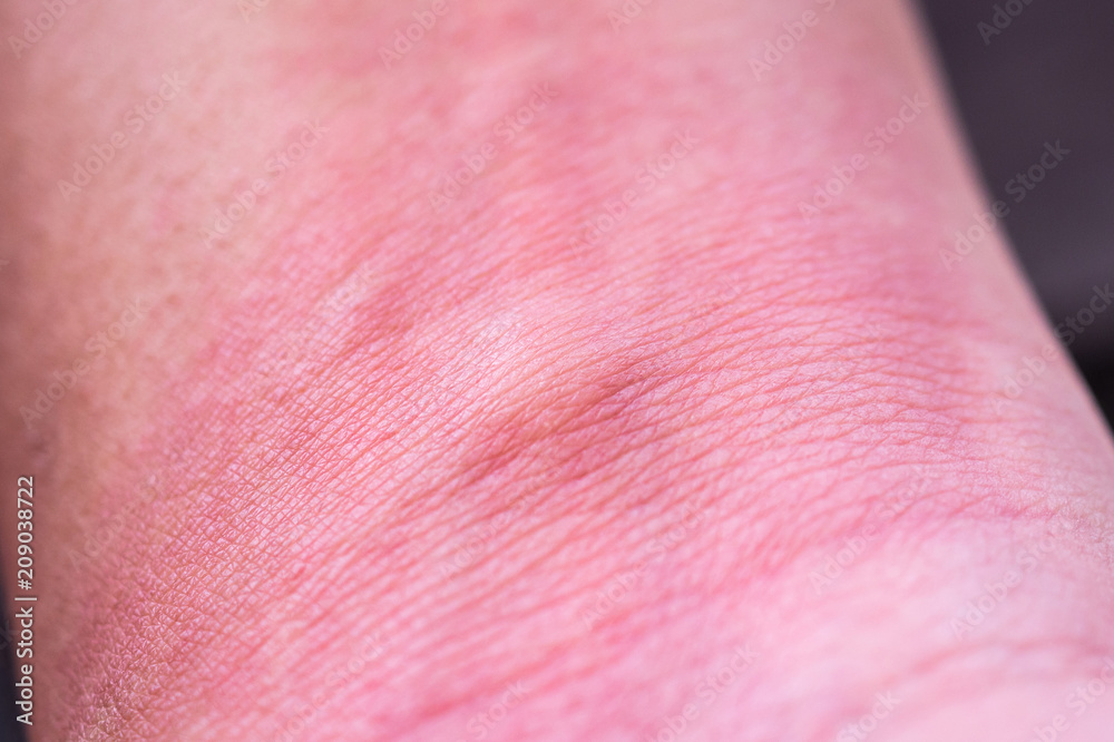 skin allergy with rash after mosquito bite skin allergy with rash after mosquito bite