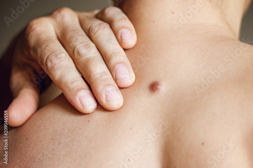 Fibroma on the male back, details, close-up