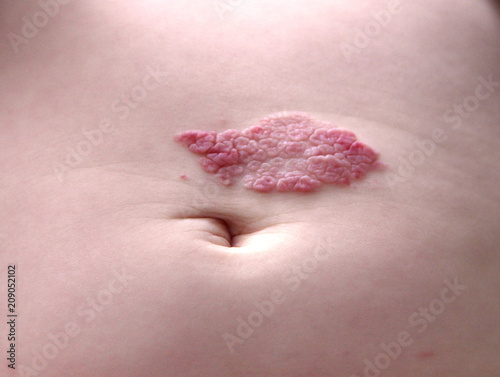Capillary hemangioma regression. Red birthmark on the baby's belly after treatment photo