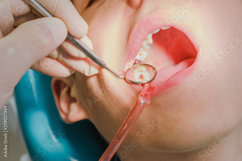 Dental treatment in the dental clinic. Rotten carious tooth close-up macro. Treatment of endodontic canals