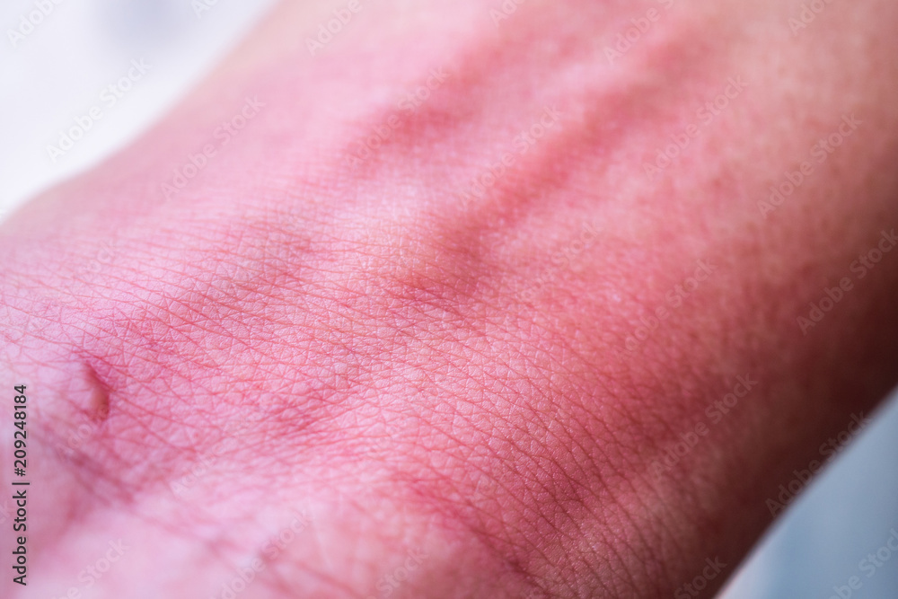 Fototapeta premium skin allergy with rash after mosquito bite
