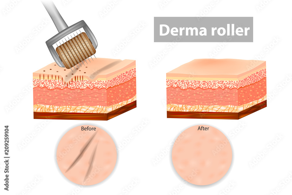 Derma roller or Meso-roller. Skin before and after application Roller for  mesotherapy. Vector illustration Stock-Vektorgrafik | Adobe Stock