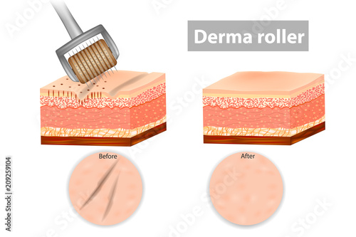 Derma roller or Meso-roller. Skin before and after application Roller for mesotherapy. Vector illustration photo