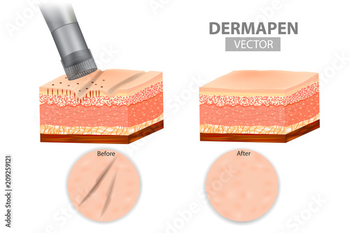 DERMAPEN. Microneedle stamping device. Skin before and after application Collagen induction therapy. Vector illustration photo