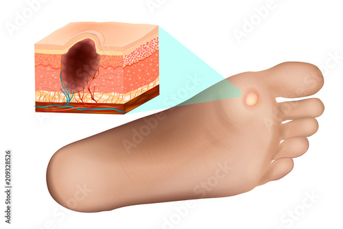 Cross section of a common wart. Anatomy Wart on  Foot.