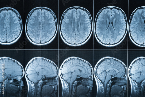 Magnetic resonance imaging of the head, MRI photo