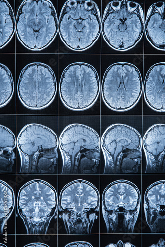 Magnetic resonance imaging of the head and brain, MRI