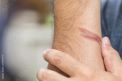 Obraz na plátne Burning skin on arm, Injury from fire