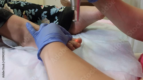 woman remove nail fungus on feet with laser treatment at clinic