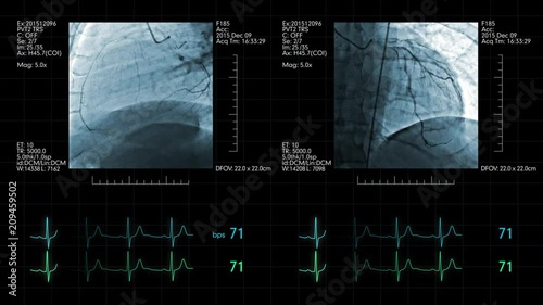Cardiovascular angiogram with heart rate monitoring display photo