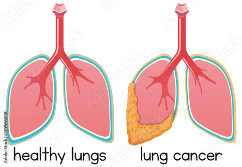 A Cartoon of Lung Condition
