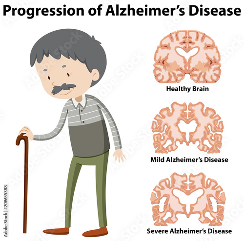 Progression of Alzheimer's disease