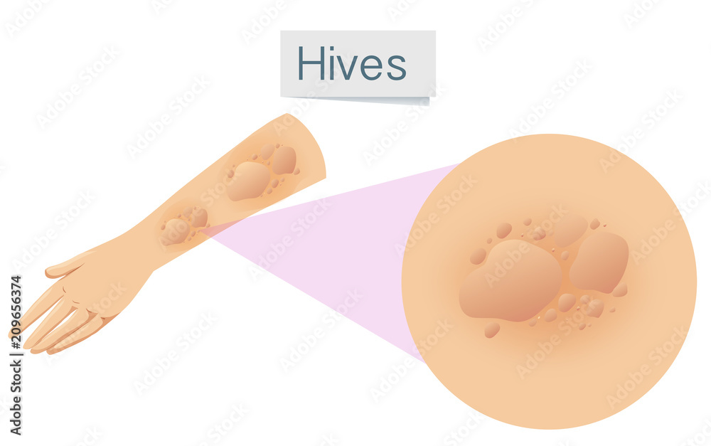 custom made wallpaper toronto digitalMagnified hives on arm
