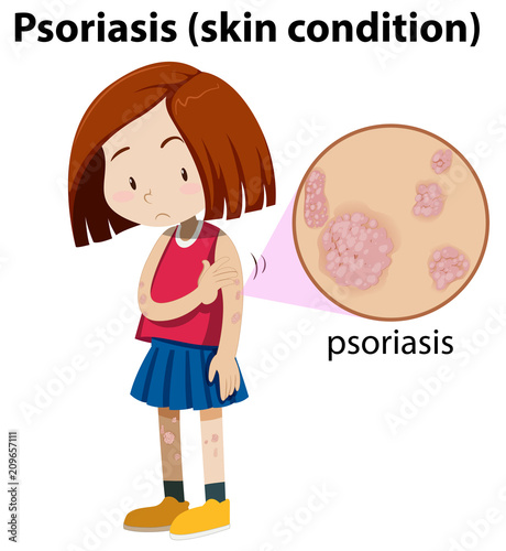 Young girl with magnified psoriasis