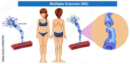 A Human Anatomy of Multiple Sclerosis