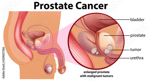 Diagram of prostate cancer photo
