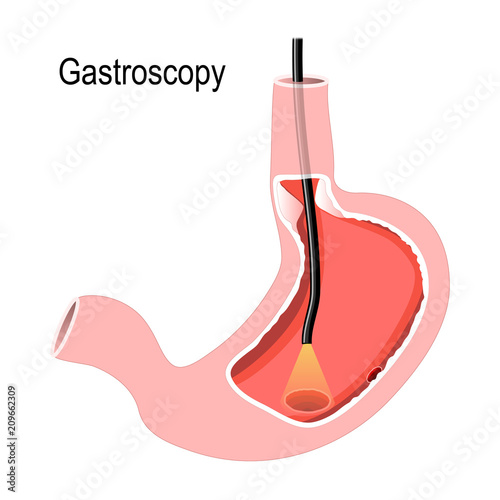 Human Stomach with endoscope