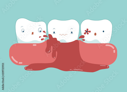 Gingivitis of dental and blood vector