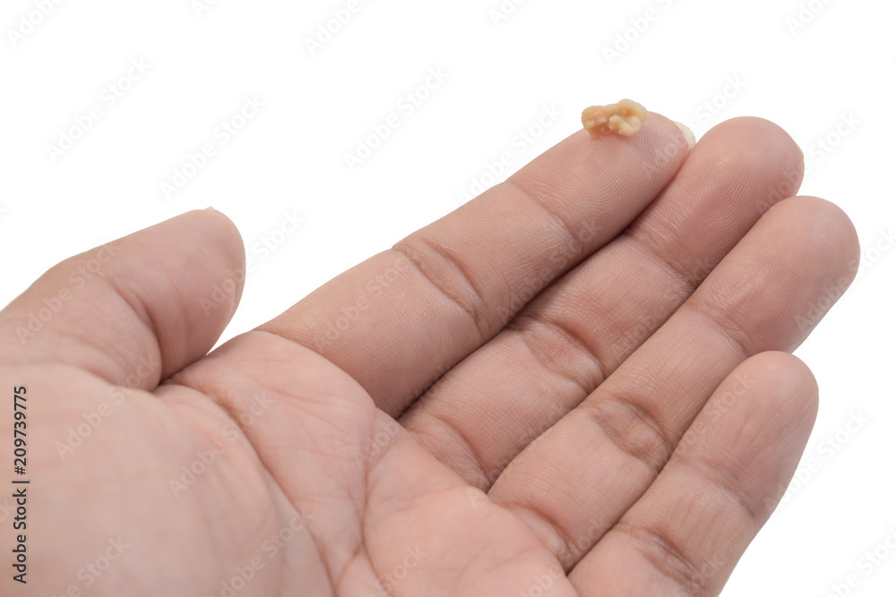 Tonsil Stone or Tonsillolith on the palm isolated on white background. Tonsil stones are hard deposits of debris that have lodged in tonsils. Tonsil Stone or Tonsillolith on the palm isolated on white background. Tonsil stones are hard deposits of debris that have lodged in tonsils.
