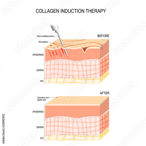Collagen induction therapy. microneedling the skin photo