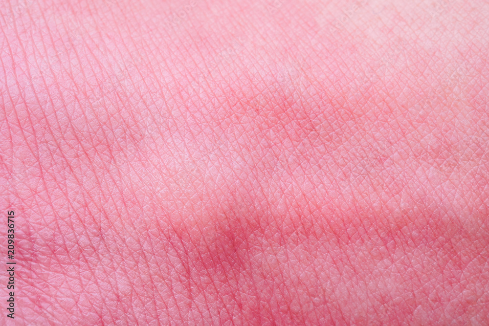 Fototapeta premium skin allergy with rash after mosquito bite