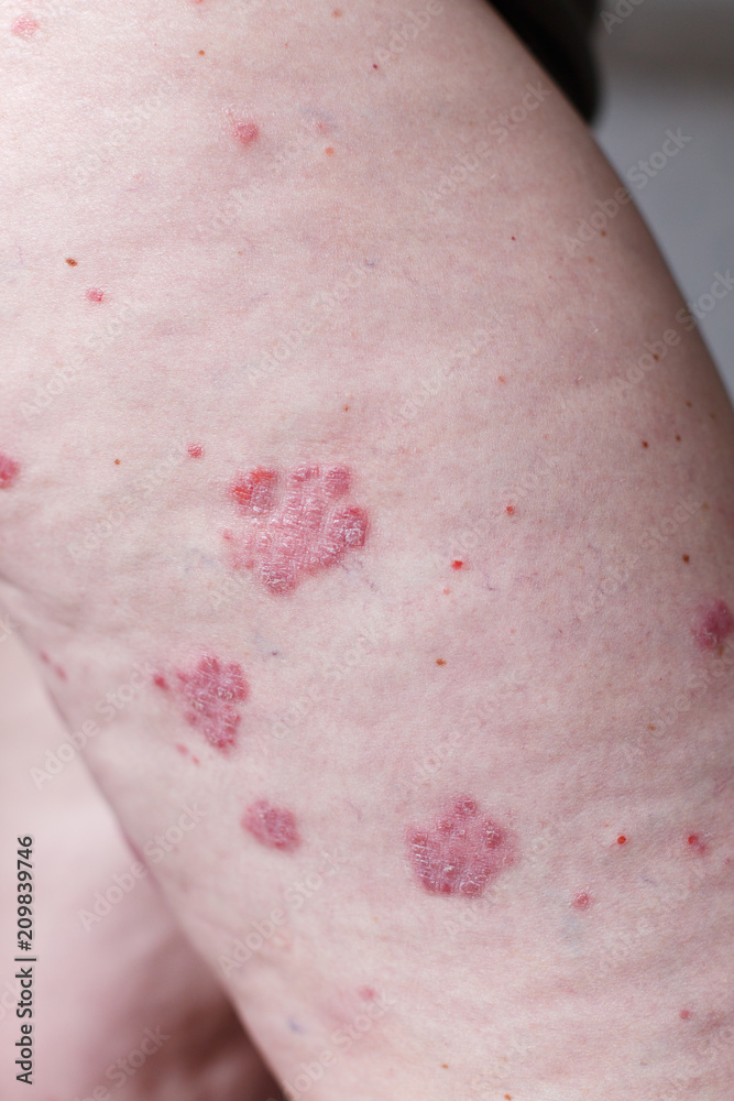 Allergic rash dermatitis eczema skin on leg of patient. Psoriasis and