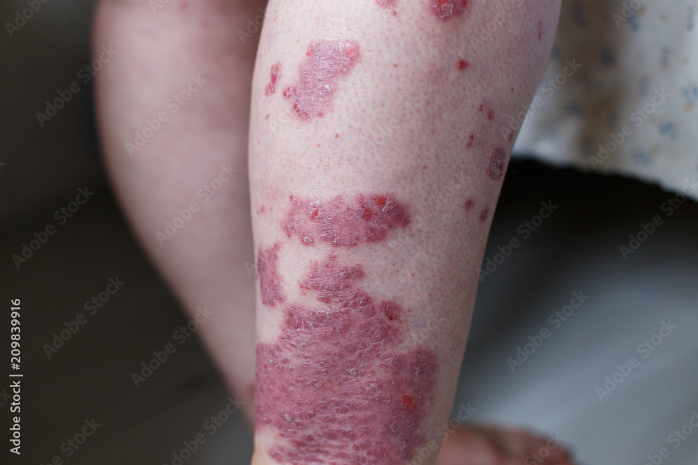 Allergic rash dermatitis eczema skin on leg of patient. Psoriasis and eczema skin with big red spots. Health concept Allergic rash dermatitis eczema skin on leg of patient. Psoriasis and eczema skin with big red spots. Health concept