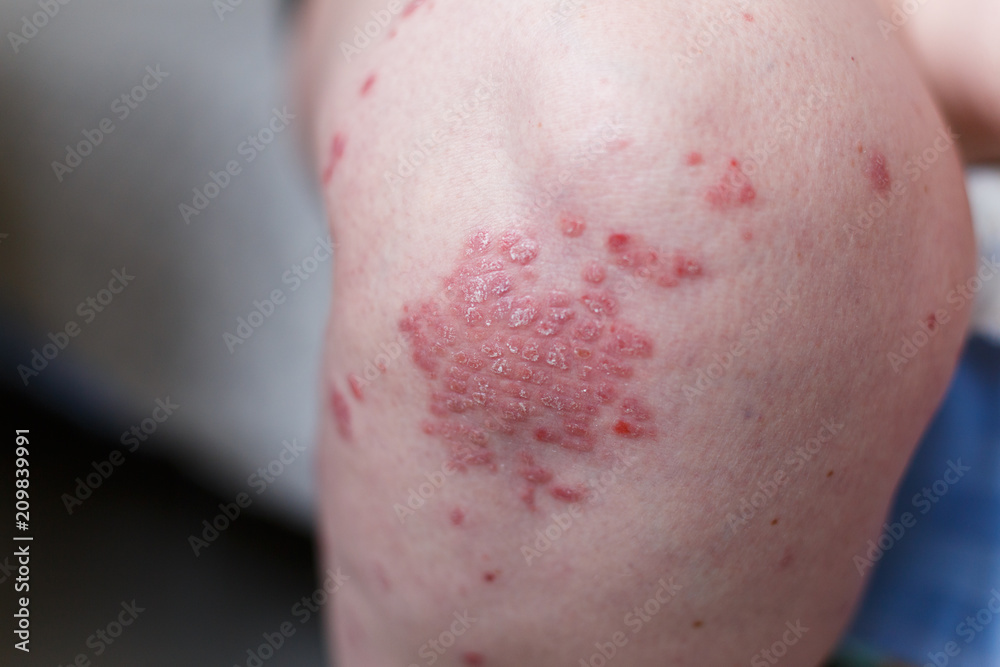 Allergic rash dermatitis eczema skin on leg of patient. Psoriasis and