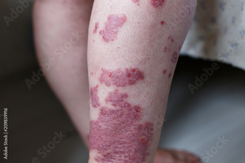 Allergic rash dermatitis eczema skin on leg of patient. Psoriasis and eczema skin with big red spots. Health concept