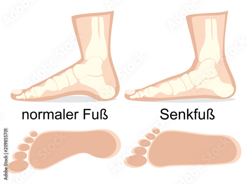 Darstellung normaler Fuß und Senkfuß im Vergleich 