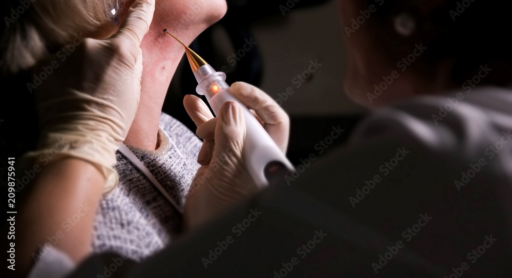  removal of papillomas, moles with a laser instrument in medical conditions. cosmetology services.
