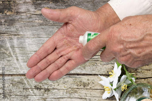 Eczema on the hands. Ointment on the hands of an elderly person.  photo